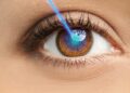Tips to Prep for Lasik Eye Surgery and Ease Recovery